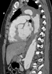 Aortic Dissection - CTisus CT Scan