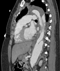 Aortic Dissection - CTisus CT Scan