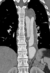 Aortic Dissection - CTisus CT Scan