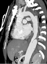 Aortic Dissection - CTisus CT Scan