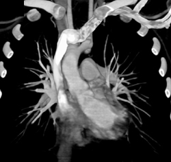 Incomplete Double Arch - CTisus CT Scan