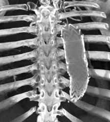 Endovascular Stents - CTisus CT Scan