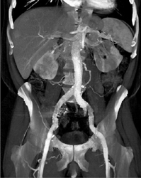 Endoleak With Feeding Vessel - CTisus CT Scan