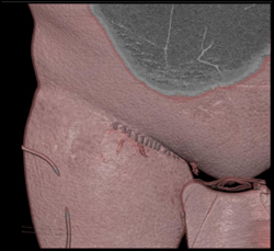 Pseudoaneurysm - CTisus CT Scan