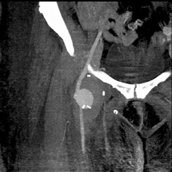 Pseudoaneurysm - CTisus CT Scan