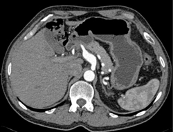 Celiac Aa Aneurysm - CTisus CT Scan