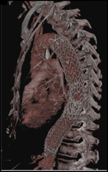 Endovascular Stent - CTisus CT Scan