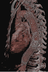 Endovascular Stent - CTisus CT Scan