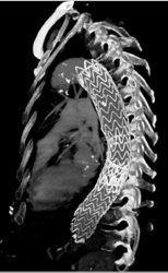 Endovascular Stent - CTisus CT Scan