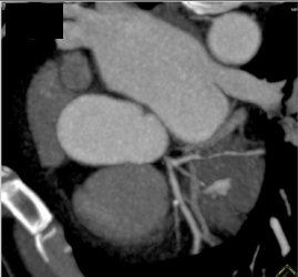 Circumflex Aa Stenosis - CTisus CT Scan