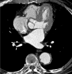 Dilated Aortic Arch - CTisus CT Scan