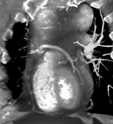 Saphenous Bypass Graft - CTisus CT Scan