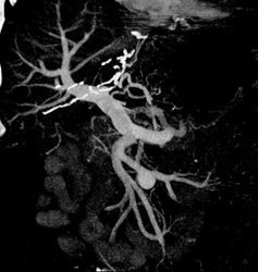 Aneurysm Off Branch of Superior Mesenteric Vein (SMV) - CTisus CT Scan