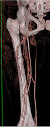 CTA With Stenosis Superficial Femoral Artery (SFA) - CTisus CT Scan