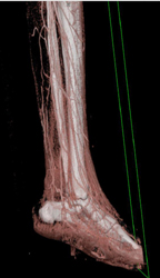 Cellulitis With Ulceration - CTisus CT Scan