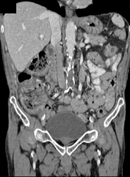 Occluded Aorta at L-4 With Collaterals in Abdominal Wall - CTisus CT Scan