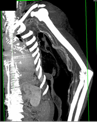 Vascular Calcification on CTA of Brachial Aa - CTisus CT Scan