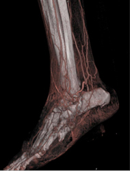 Runoff - CTisus CT Scan