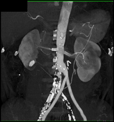 Patent Stents in Renal Artery of Prior Abdominal Aorta Repair - CTisus CT Scan