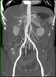 Nice Bone Removal for Evaluation of the Aorta - CTisus CT Scan