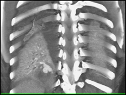 Pseudoaneurysm of Right Lower Lobe in An Intravenous Drug Abuse (IVDA)Patient - CTisus CT Scan