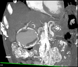 Hepatic Artery Aneurysm >6 Cm - CTisus CT Scan