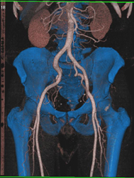 Pretty Aorta and Iliacs - CTisus CT Scan