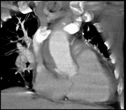 Leak From Aortic Root - CTisus CT Scan