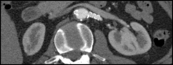 Patent Stents - CTisus CT Scan