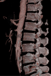 Stenosis SMA - CTisus CT Scan