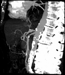 Proximal Stenosis of Celiac Aa - CTisus CT Scan