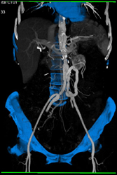 SMA Shunt Graft - CTisus CT Scan