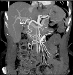 Superior Mesenteric Artery (SMA) Stenosis - CTisus CT Scan