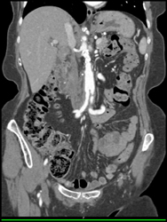 Superior Mesenteric Artery (SMA) Stenosis - CTisus CT Scan