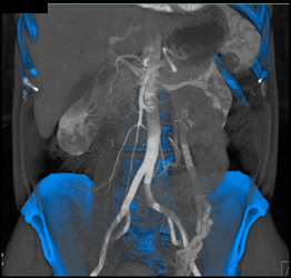 Prominent Left Gonadal Vein - CTisus CT Scan