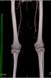 Occlusion of Distal Left Superficial Femoral Artery (SFA) - CTisus CT Scan