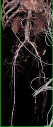 Diseased SFA With Occluded Left SFAs - CTisus CT Scan