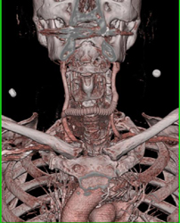 Carotid to Carotid Bypass - CTisus CT Scan