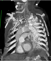 Endovascular Thoracic Stent - CTisus CT Scan