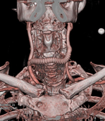 Carotid to Carotid Bypass Graft - CTisus CT Scan