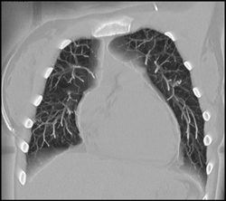 Small Pulmonary Arteriovenous Malformations (AVMs) - CTisus CT Scan