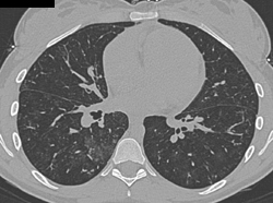 Pulmonary Hemorrhage - CTisus CT Scan