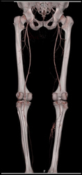 Occluded Popliteal Aa S/P Trauma - CTisus CT Scan