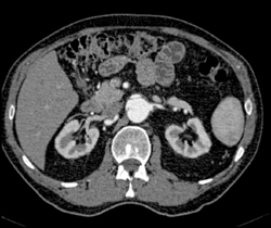 Aortic Dissection - CTisus CT Scan