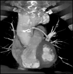 Bypass Grafts - CTisus CT Scan