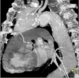 Ascending Aorta of Arch Aneurysm - CTisus CT Scan