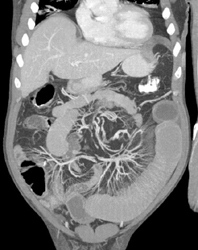 Crohn's With Dilated Mesenteric Vessels - CTisus CT Scan