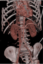 CTA of Bifurcation - CTisus CT Scan