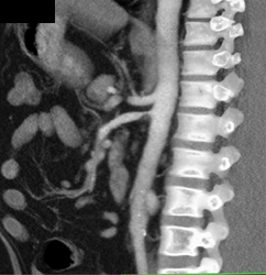 Stenosis SMA With Soft Plaques - CTisus CT Scan