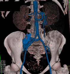 Demo of Bone Segmentation - CTisus CT Scan